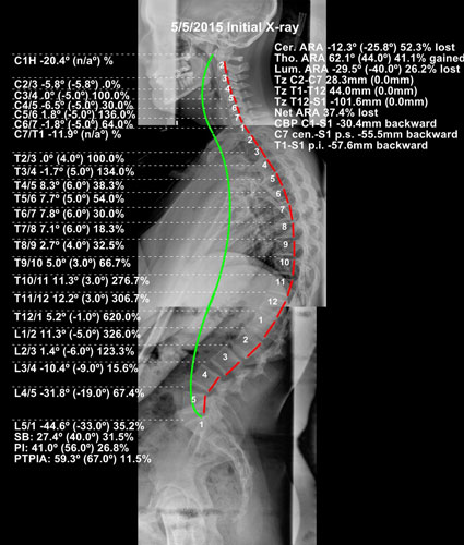 Chiropractic Urbandale IA Before