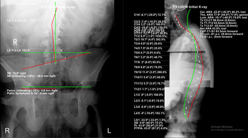 Chiropractic Urbandale IA Digital X Ray